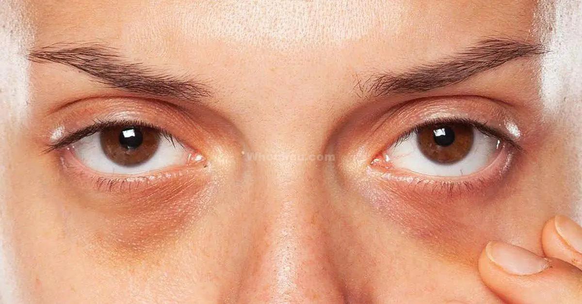 6 remèdes de grand-mère contre les yeux fatigués